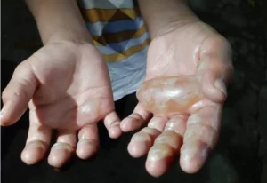 Leia mais sobre o artigo Mãe que queimou as mãos do filho é indiciada por tortura