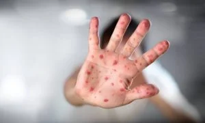 Leia mais sobre o artigo Autoridades sanitárias do Rio entram em alerta por surto de sarampo