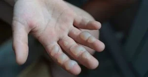 Leia mais sobre o artigo Mãe joga água quente no filho de 7 anos por ele tomar todo o achocolatado da casa