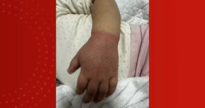 Leia mais sobre o artigo Criança de 2 anos quase perde braço em Manaus após elástico de cabelo impedir circulação sanguínea